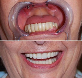 cost teeth implants usa