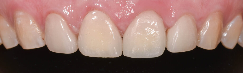 After Image: Veneers on the central incisors - front