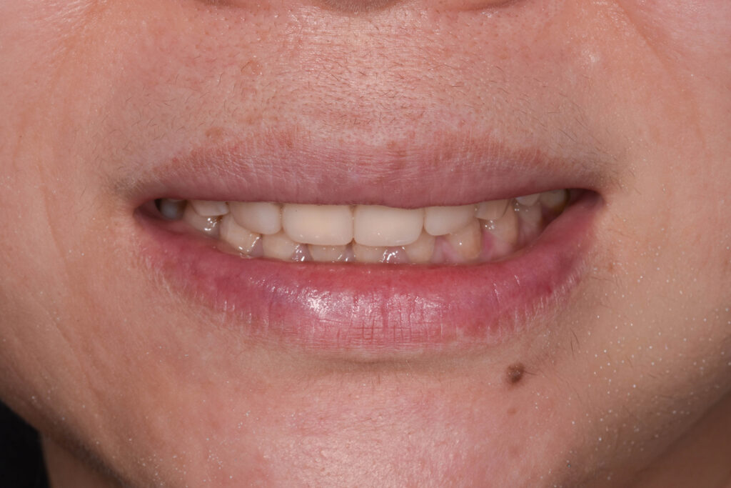 After Image: Veneers on the central incisors - front