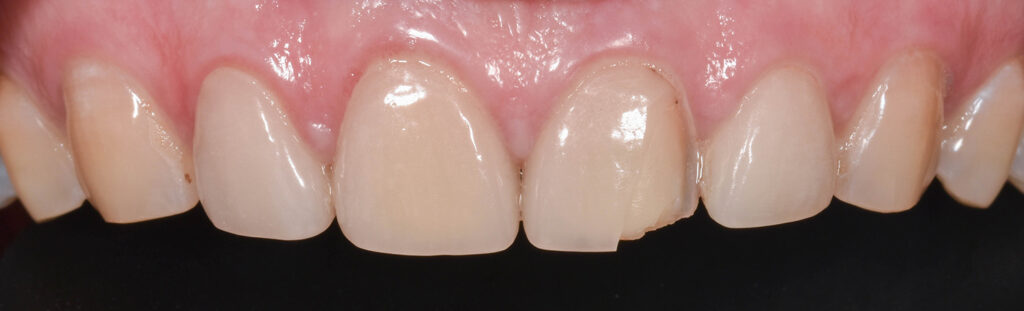 Before Image: Veneers on the central incisors - front