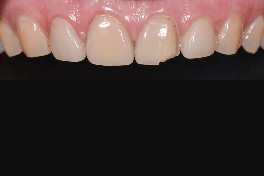 Before Image: Veneers on the central incisors - front